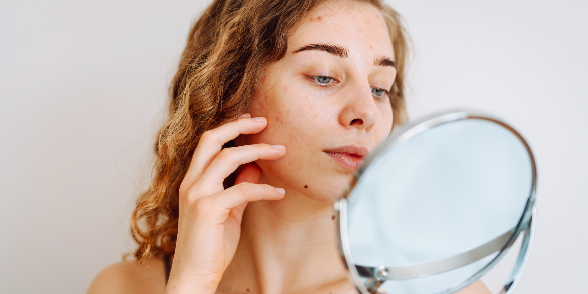 Jak zlikwidować zaczerwienienia na twarzy?